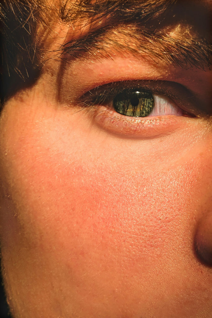 Close up of face with sunburn | sunscreen maths