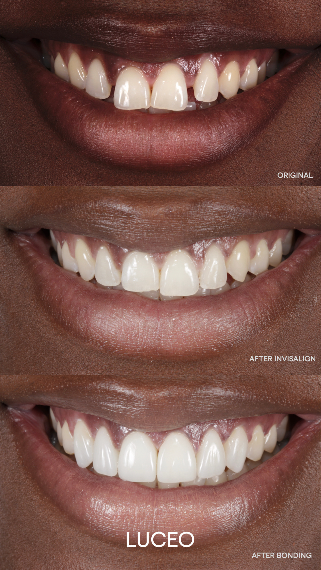 Invisalign before and after